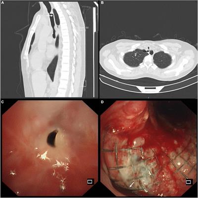 Management of stent-related tracheoesophageal fistula in complex post-tuberculosis tracheobronchial stenosis: A case report